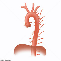 Aorta descendente