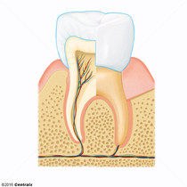 Coroa Dentria