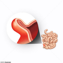 Divertculo Ileal