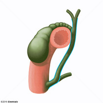 Ductos Biliares Extra-Hepticos
