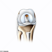 Ligamento Cruzado Anterior