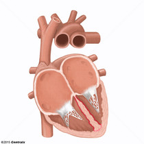 Septo Interventricular