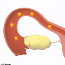 Tubas Uterinas