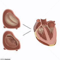 Valva Mitral